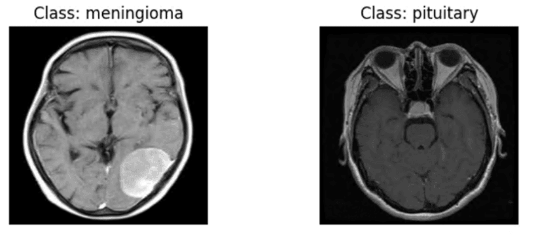 Brain Tumor Detector